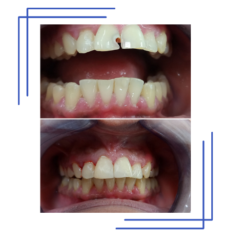 Smile Transformation 2