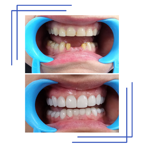 Smile Transformation 3