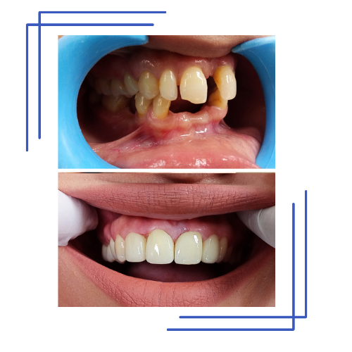 Smile Transformation 1