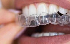 Clear Aligners